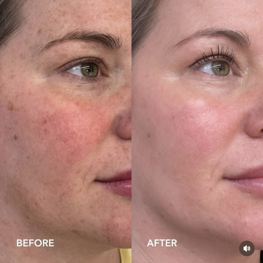 ZO SKIN HEALTH Retinol + Blemish Complex