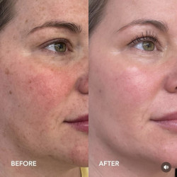 ZO SKIN HEALTH Retinol + Blemish Complex