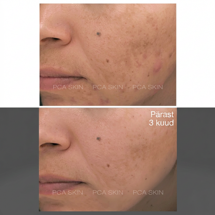 PCA Skin Blemish Control Bar