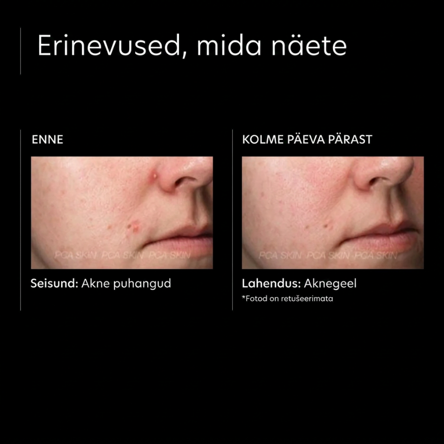 PCA Skin acne gel