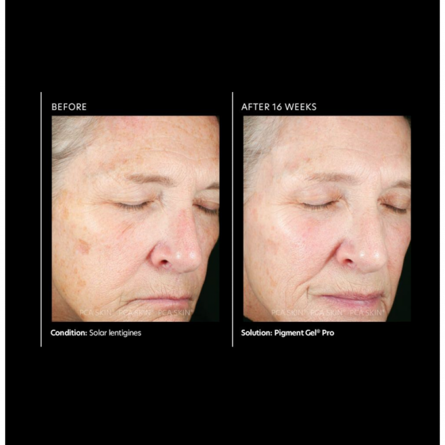 PCA Skin Pigment Gel Pro 29 ml